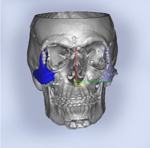 CBCT-scan voor PEEK