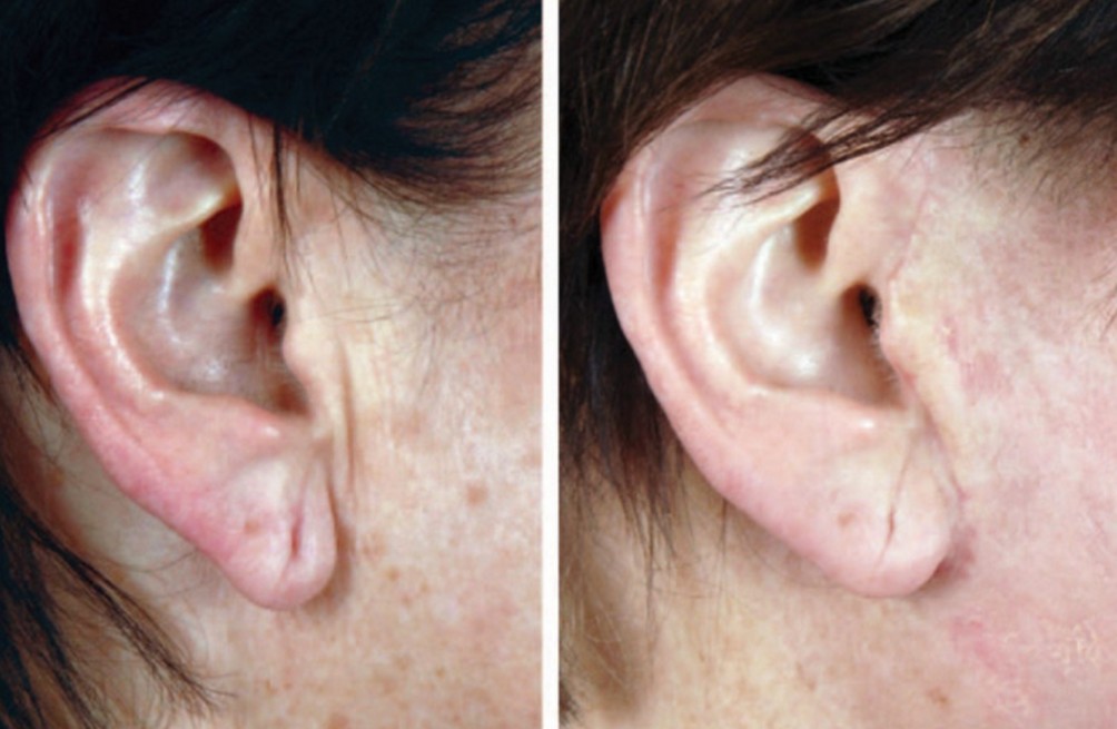 Deep Plane Facelift - o2 Clinic