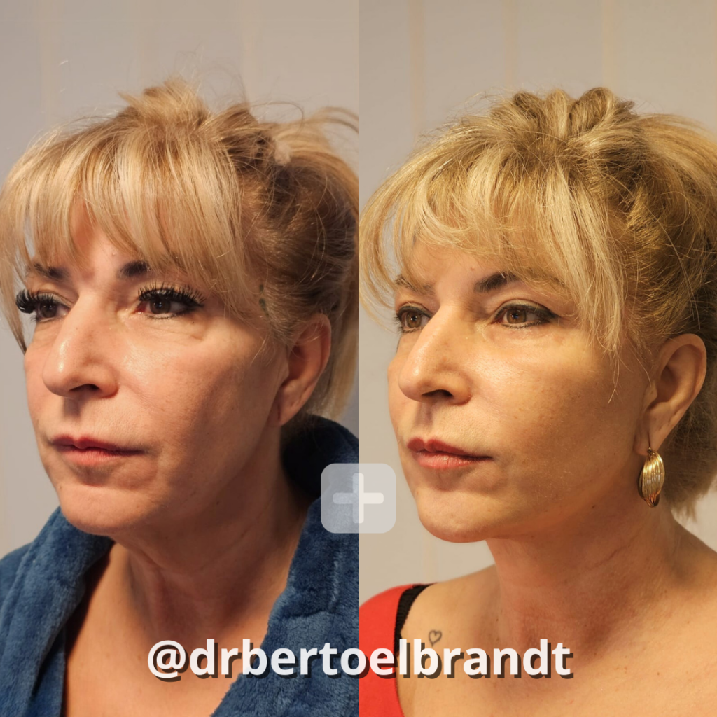 Deep Plane Facelift - o2 Clinic