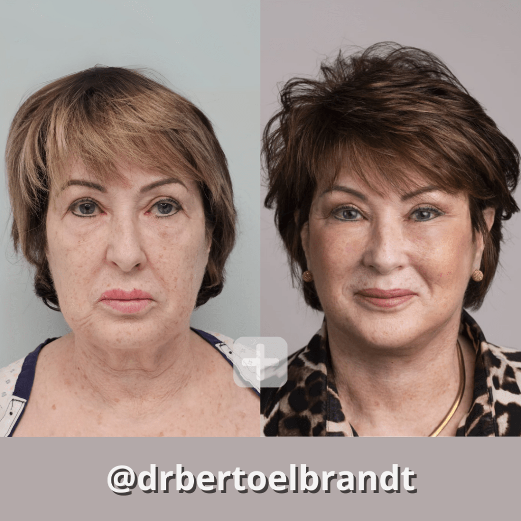 Deep Plane Facelift - o2 Clinic