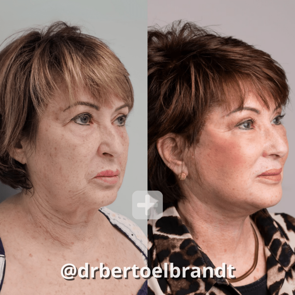 Deep Plane Facelift - o2 Clinic