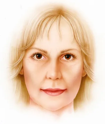 Deep Plane Facelift - o2 Clinic