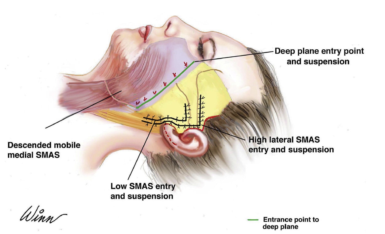 Deep Plane Facelift - o2 Clinic