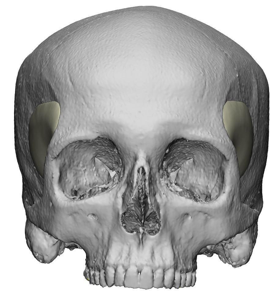 Temporele PEEK-implantaten - o2 Clinic