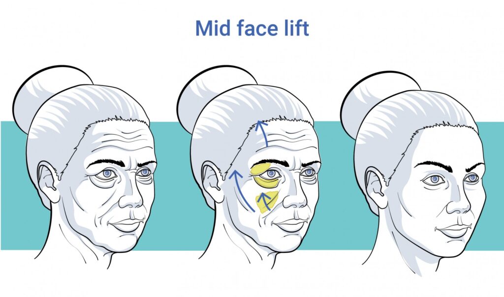 Midfacelift