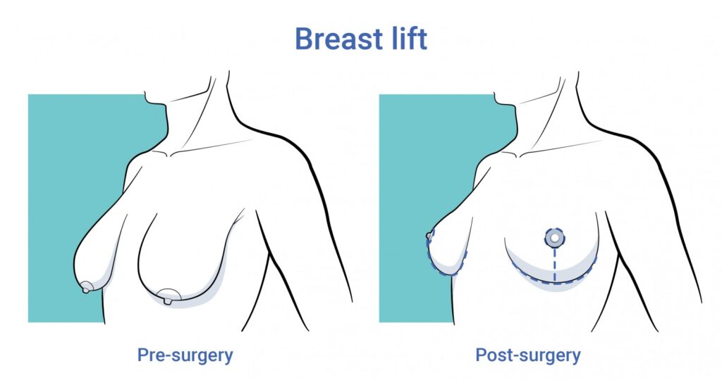 Borstlift - o2 Clinic