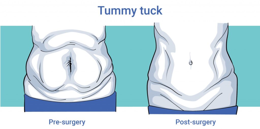 Buikwandcorrectie - o2 Clinic