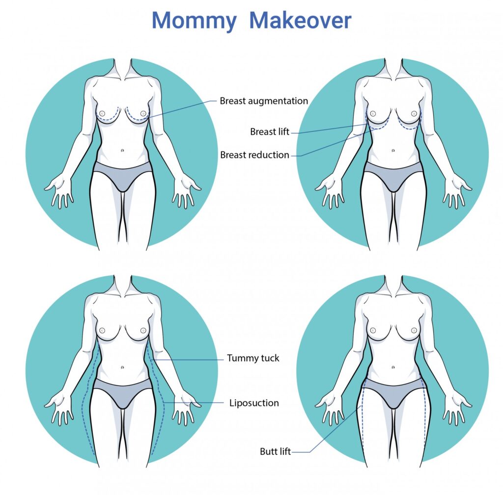 Mommy makeover - o2 Clinic