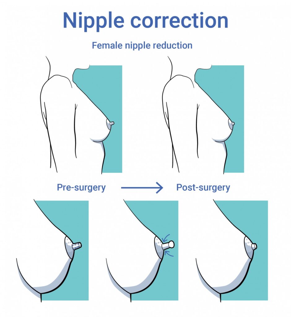 Tepelcorrectie - o2 Clinic