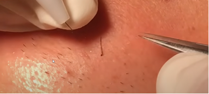 Ingegroeide haren rondom de intieme zone? Zo helpen we u bij o2 Clinic voorgoed van die irritatie af - o2 Clinic Ingegroeide haren rondom de intieme zone? Zo helpen we u bij o2 Clinic voorgoed van die irritatie af - o2 Clinic